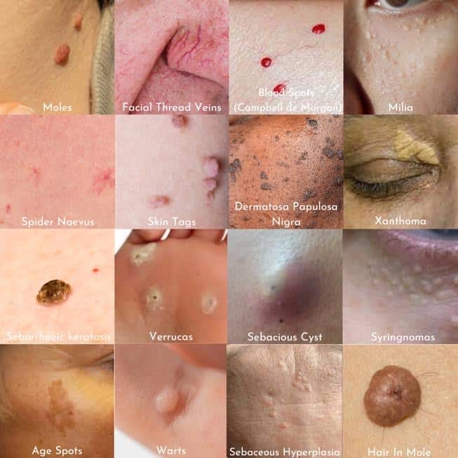 Image: Advanced Blemish Removal Through Electrolysis. Discover the transformative power of electrolysis for flawless skin. Schedule your consultation today.